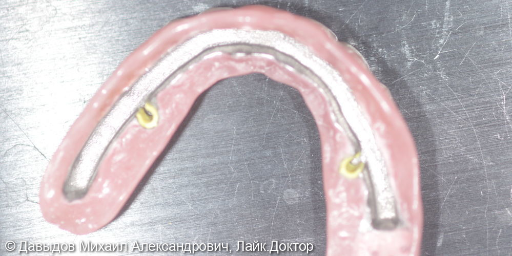 Функциональное протезирование зубов верхней и нижней челюсти с использование бюгельного протеза с замковобалочной фиксацией на имплантах и кламерного бюгельного протеза - фото №12
