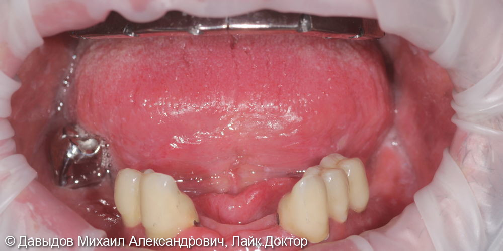 Функциональное протезирование зубов верхней и нижней челюсти с использование бюгельного протеза с замковобалочной фиксацией на имплантах и кламерного бюгельного протеза - фото №16