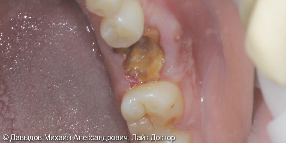 Одномоментная имплантация зуба 36 - фото №1