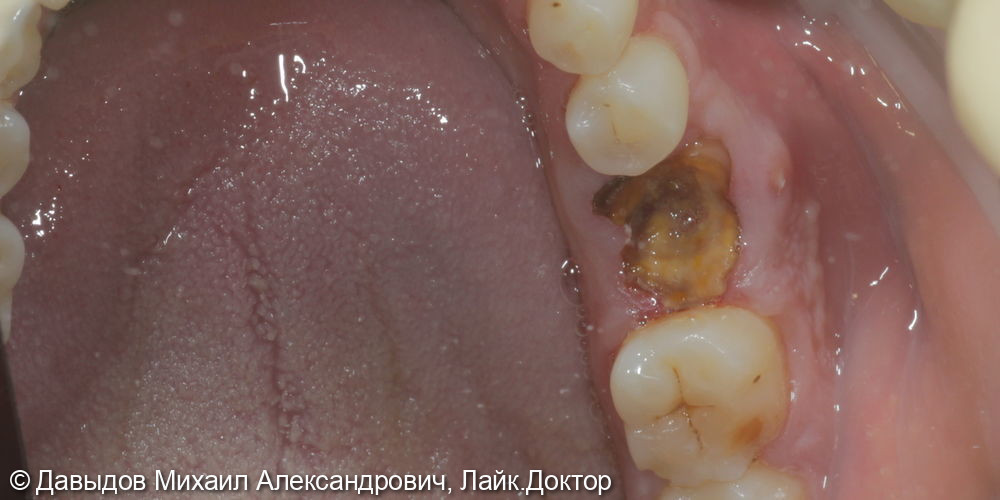 Одномоментная имплантация зуба 36 - фото №2