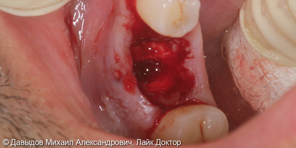 Одномоментная имплантация зуба 36 - фото №3