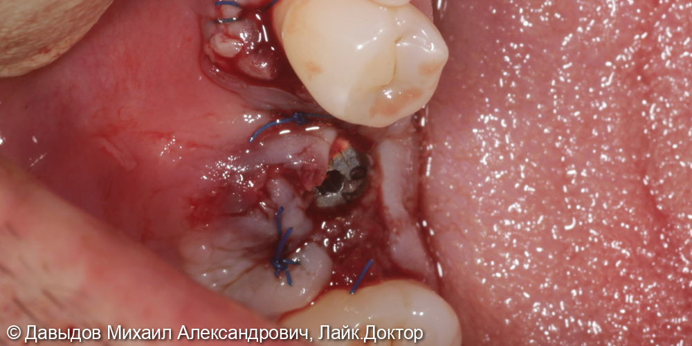 Одномоментная имплантация зуба 36 - фото №4