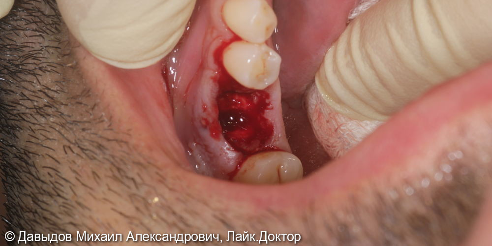 Одномоментная имплантация зуба 36 - фото №6