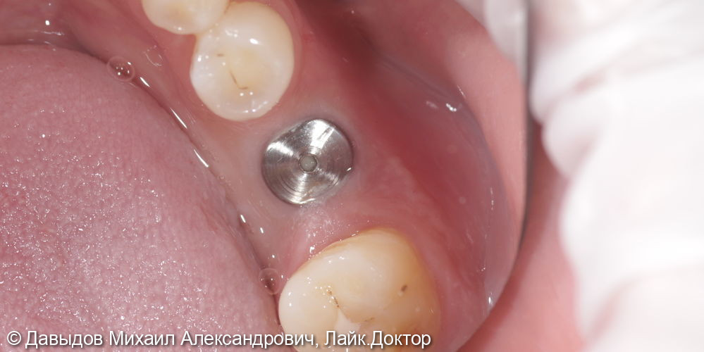 Одномоментная имплантация зуба 36 - фото №7