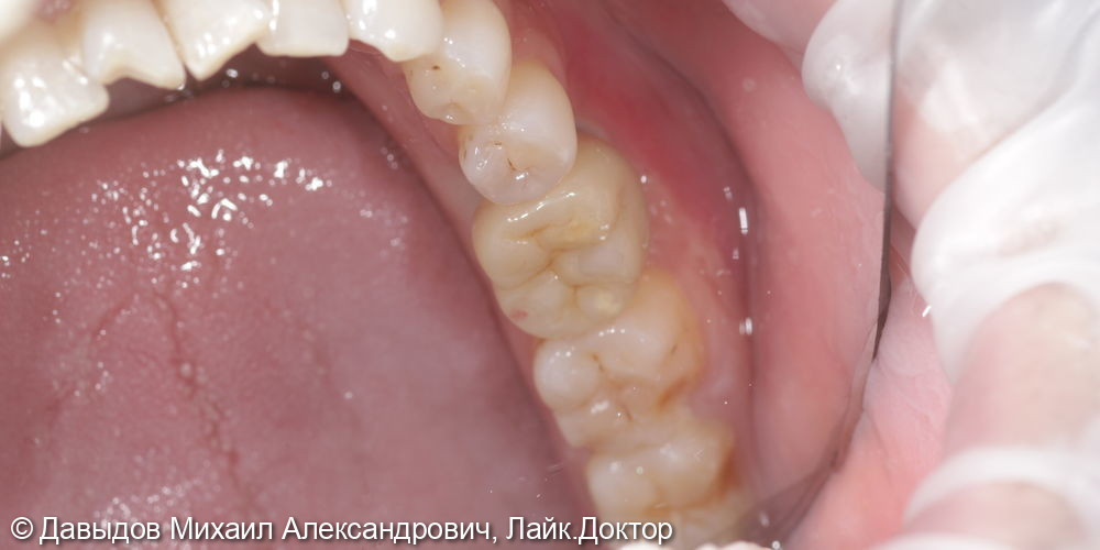Одномоментная имплантация зуба 36 - фото №9
