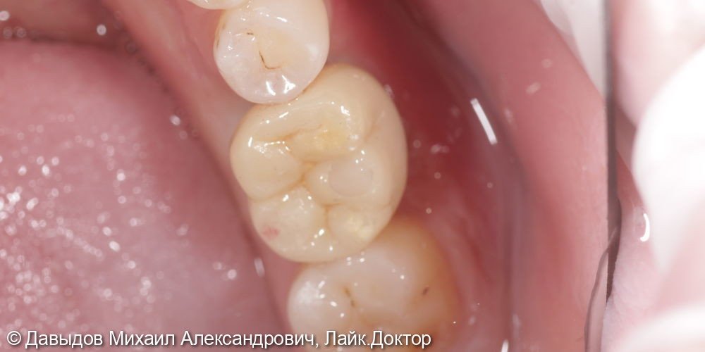 Одномоментная имплантация зуба 36 - фото №10