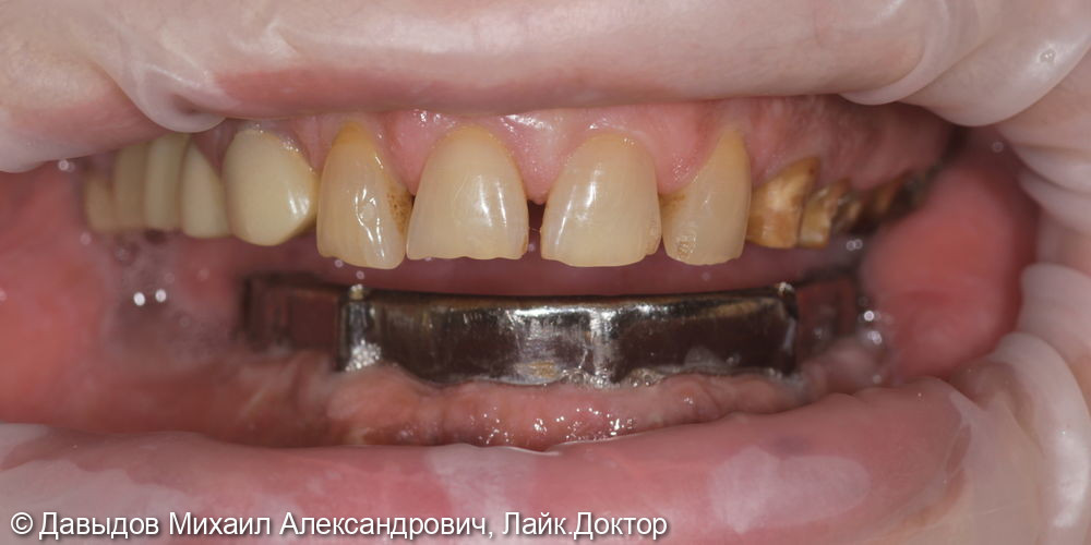Зубы за один день. Одномоментная имплантация с немедленной нагрузкой временными коронками - фото №1