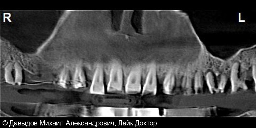 Зубы за один день. Одномоментная имплантация с немедленной нагрузкой временными коронками - фото №2