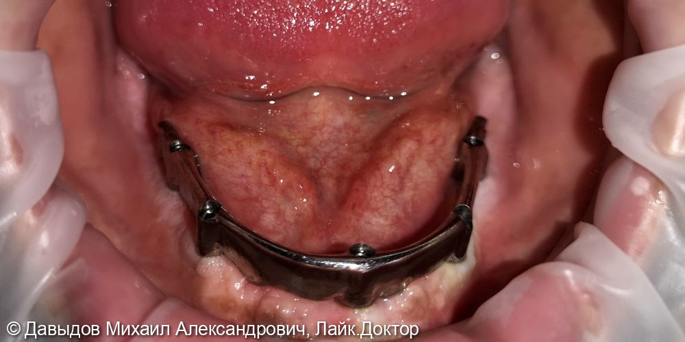Зубы за один день. Одномоментная имплантация с немедленной нагрузкой временными коронками - фото №3