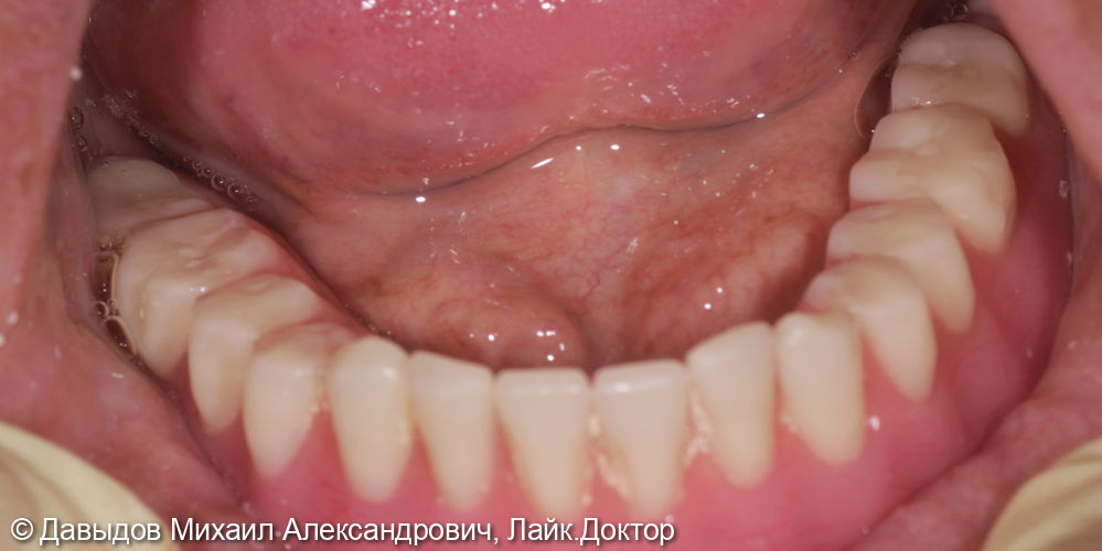Зубы за один день. Одномоментная имплантация с немедленной нагрузкой временными коронками - фото №4