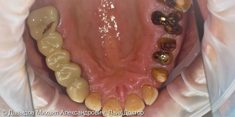 Зубы за один день. Одномоментная имплантация с немедленной нагрузкой временными коронками - фото №5
