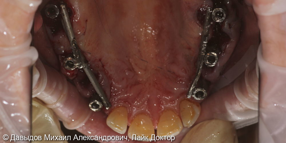 Зубы за один день. Одномоментная имплантация с немедленной нагрузкой временными коронками - фото №10