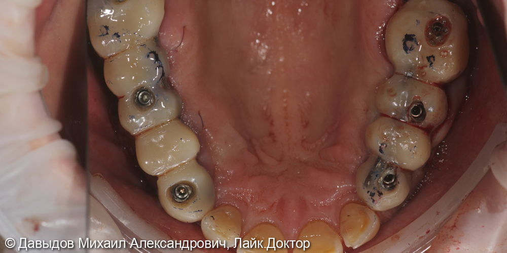 Зубы за один день. Одномоментная имплантация с немедленной нагрузкой временными коронками - фото №11