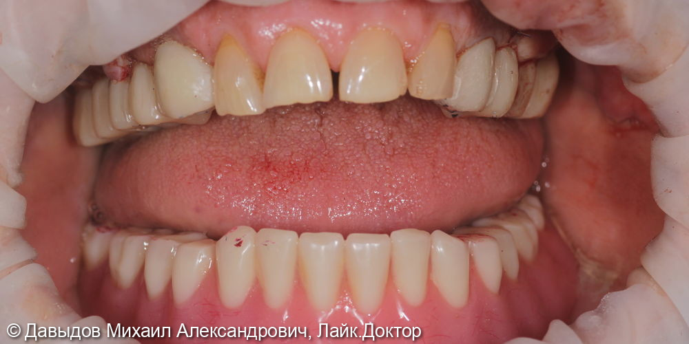 Зубы за один день. Одномоментная имплантация с немедленной нагрузкой временными коронками - фото №13