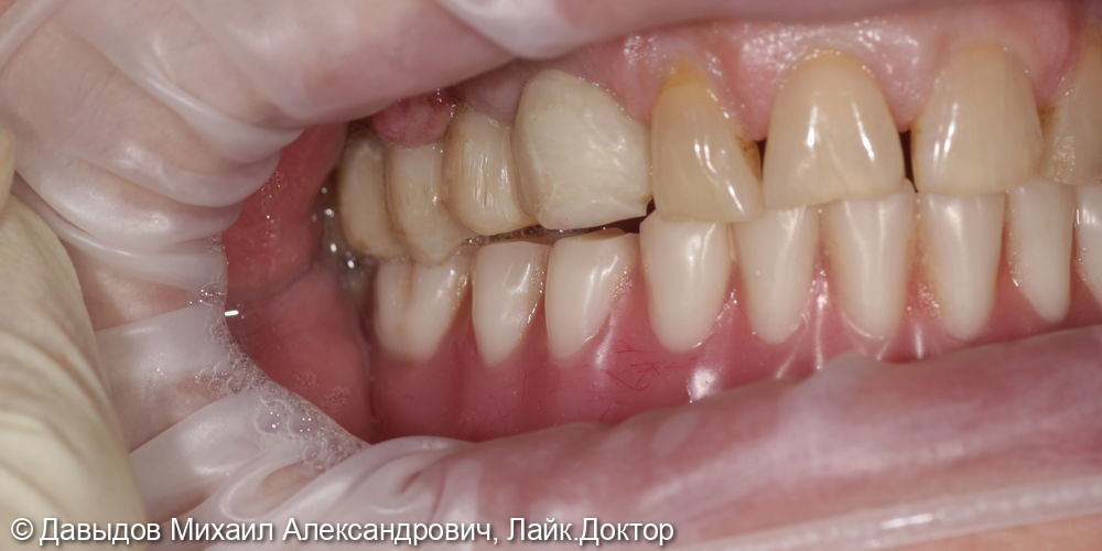 Зубы за один день. Одномоментная имплантация с немедленной нагрузкой временными коронками - фото №15