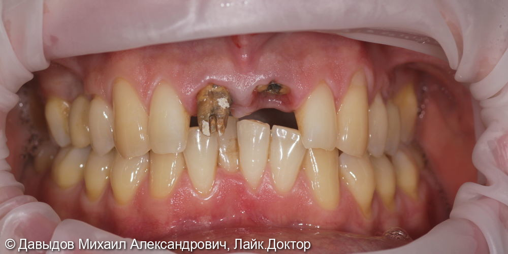 Одномоментная имплантация зуба 21. Техника корневого щита - фото №1
