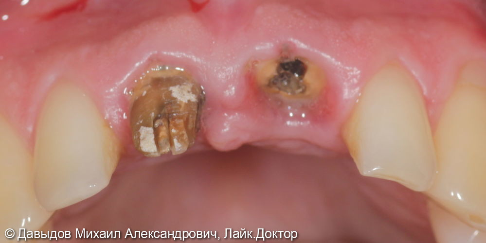 Одномоментная имплантация зуба 21. Техника корневого щита - фото №2