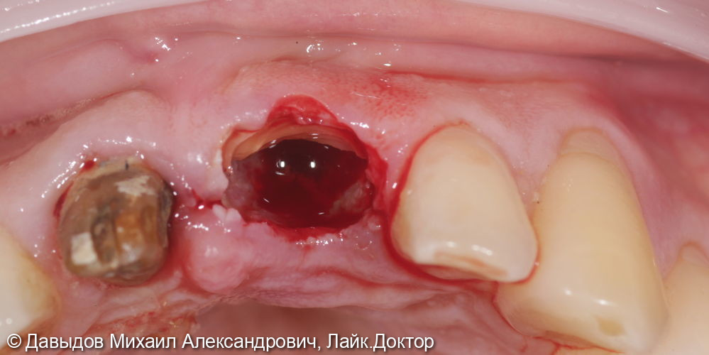 Одномоментная имплантация зуба 21. Техника корневого щита - фото №3