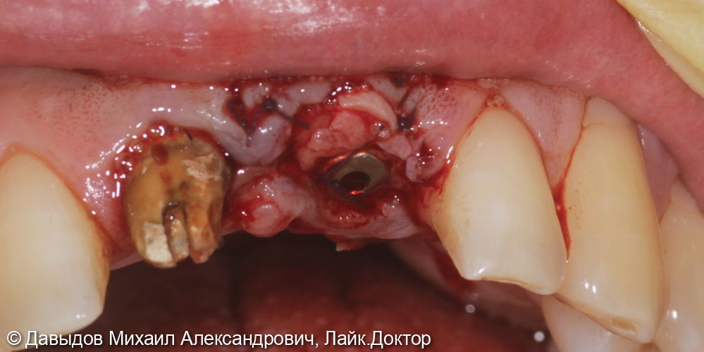 Одномоментная имплантация зуба 21. Техника корневого щита - фото №5