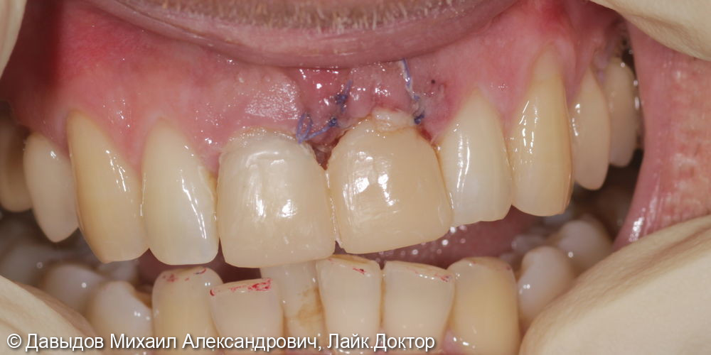 Одномоментная имплантация зуба 21. Техника корневого щита - фото №6