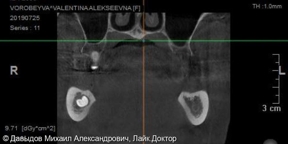 Протезирование на верхней челюсти на 6 имплантах металлокомпозитным протезом на мультиюнитах, пластика по Кури, немедленная нагрузка - фото №2