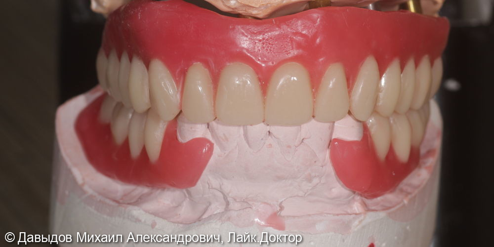 Протезирование на верхней челюсти на 6 имплантах металлокомпозитным протезом на мультиюнитах, пластика по Кури, немедленная нагрузка - фото №17