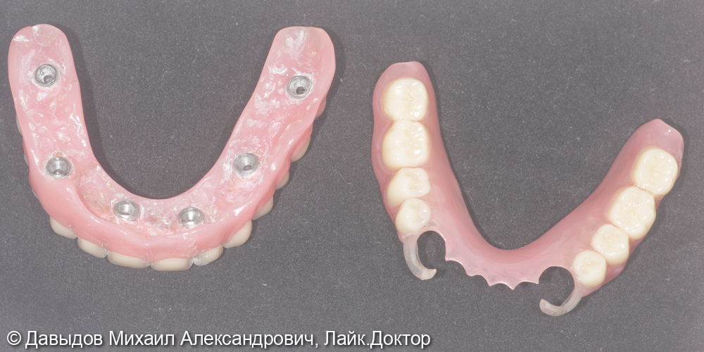 Протезирование на верхней челюсти на 6 имплантах металлокомпозитным протезом на мультиюнитах, пластика по Кури, немедленная нагрузка - фото №19