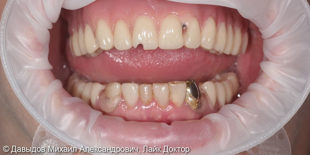 Протезирование на верхней челюсти на 6 имплантах металлокомпозитным протезом на мультиюнитах, пластика по Кури, немедленная нагрузка - фото №20