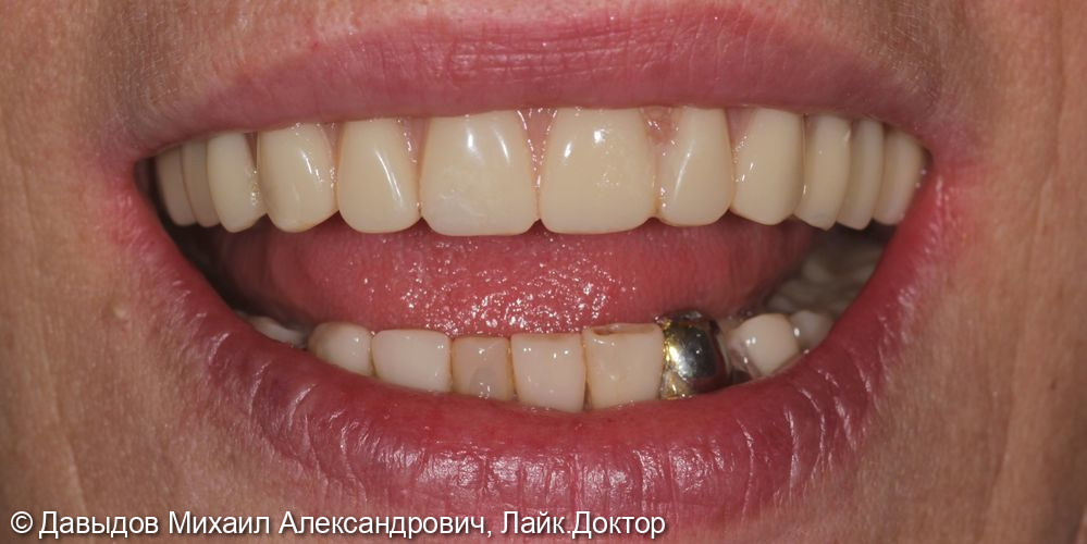 Протезирование на верхней челюсти на 6 имплантах металлокомпозитным протезом на мультиюнитах, пластика по Кури, немедленная нагрузка - фото №21
