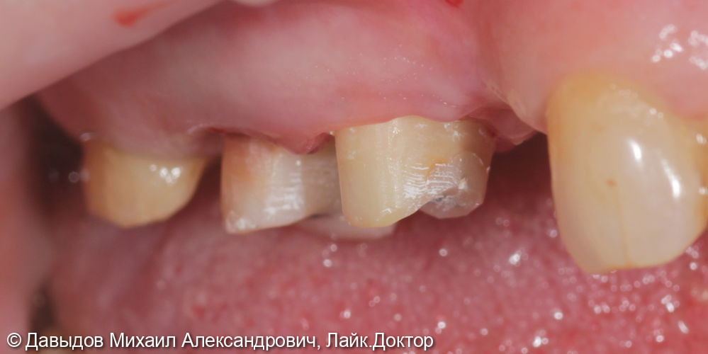 Одномоментная имплантация зуба 17, имплантация 14, временная реабилитация - фото №2