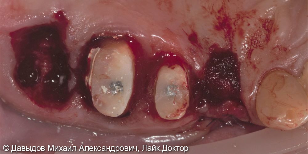Одномоментная имплантация зуба 17, имплантация 14, временная реабилитация - фото №3
