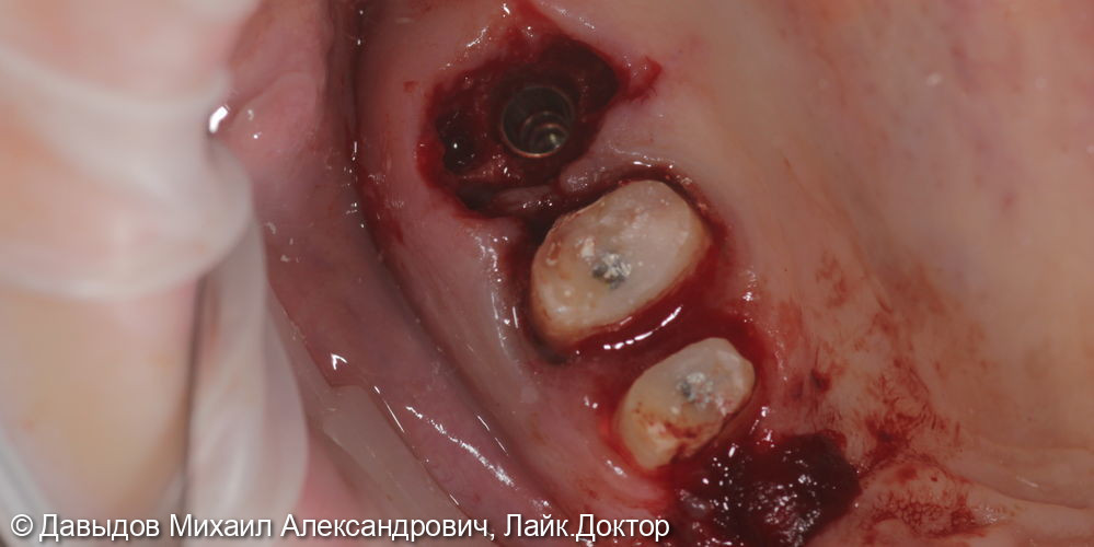 Одномоментная имплантация зуба 17, имплантация 14, временная реабилитация - фото №5