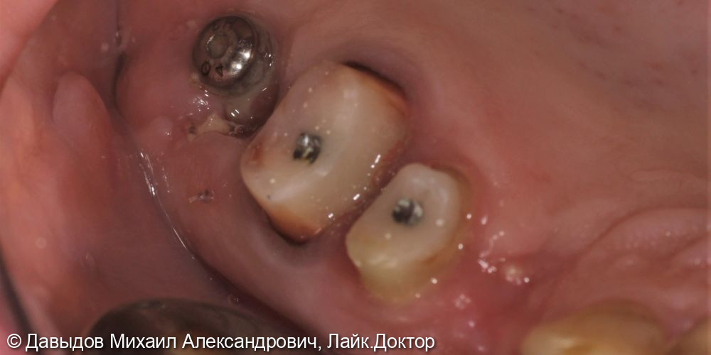 Одномоментная имплантация зуба 17, имплантация 14, временная реабилитация - фото №6