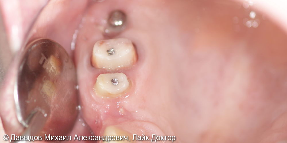 Одномоментная имплантация зуба 17, имплантация 14, временная реабилитация - фото №7