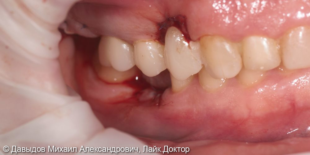 Одномоментная имплантация зуба 17, имплантация 14, временная реабилитация - фото №8