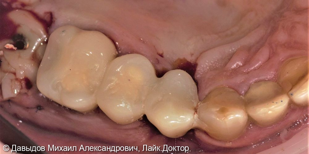 Одномоментная имплантация зуба 17, имплантация 14, временная реабилитация - фото №9