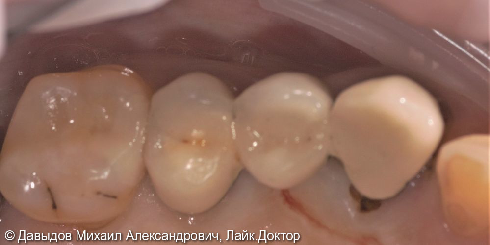 Одномоментная имплантация зубов 23, 25 - фото №1