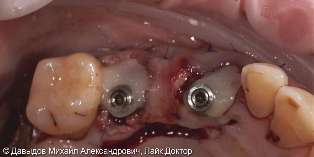 Одномоментная имплантация зубов 23, 25 - фото №6