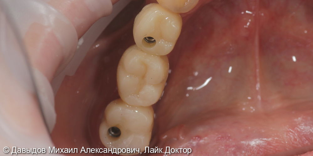 Одномоментная имплантация. Протезирование зубов на имплантах - фото №5