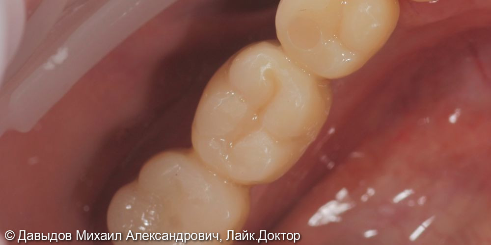 Одномоментная имплантация. Протезирование зубов на имплантах - фото №7