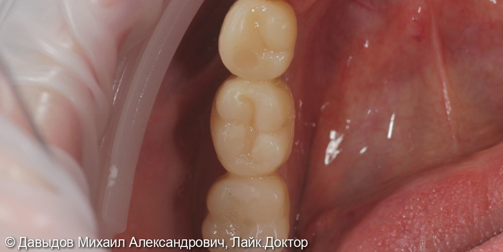Одномоментная имплантация. Протезирование зубов на имплантах - фото №8