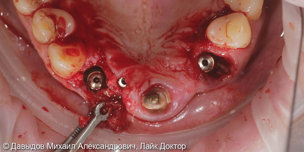 Одномоментная имплантация с немедленной нагрузкой во фронтальном отделе, протезирование металлокерамическими коронками - фото №3