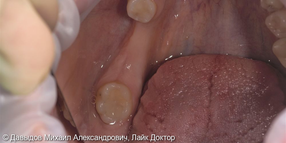 Протезирование зубов 46, 47 при помощи коронок из диоксида циркония на имплантах с винтоовой фиксацией - фото №1