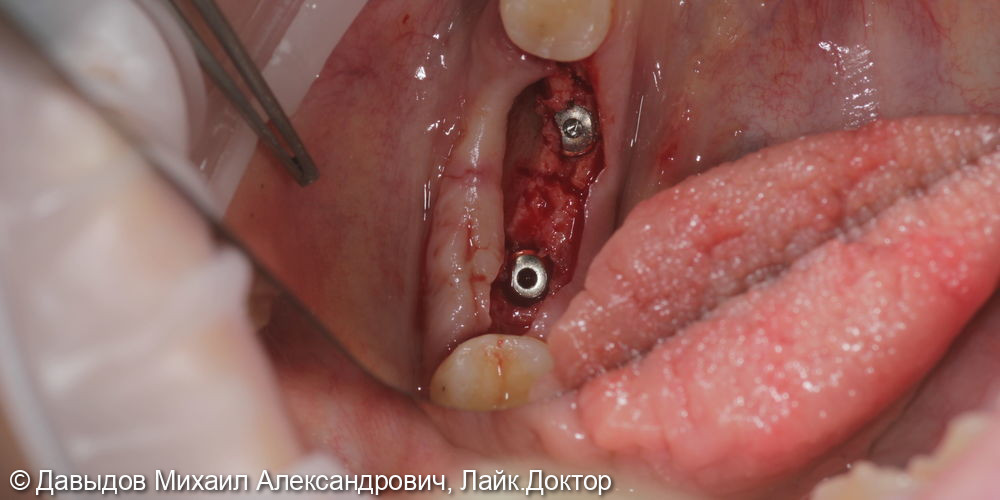Протезирование зубов 46, 47 при помощи коронок из диоксида циркония на имплантах с винтоовой фиксацией - фото №2