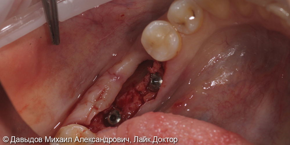 Протезирование зубов 46, 47 при помощи коронок из диоксида циркония на имплантах с винтоовой фиксацией - фото №3