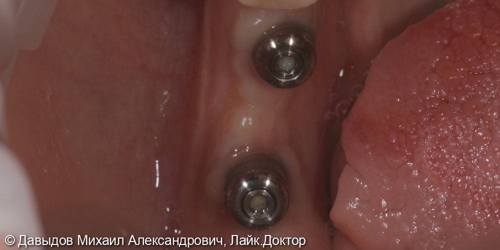 Протезирование зубов 46, 47 при помощи коронок из диоксида циркония на имплантах с винтоовой фиксацией - фото №4