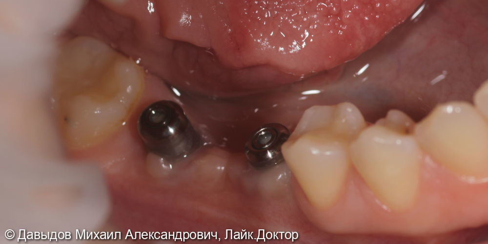 Протезирование зубов 46, 47 при помощи коронок из диоксида циркония на имплантах с винтоовой фиксацией - фото №5
