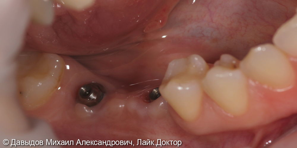 Протезирование зубов 46, 47 при помощи коронок из диоксида циркония на имплантах с винтоовой фиксацией - фото №6