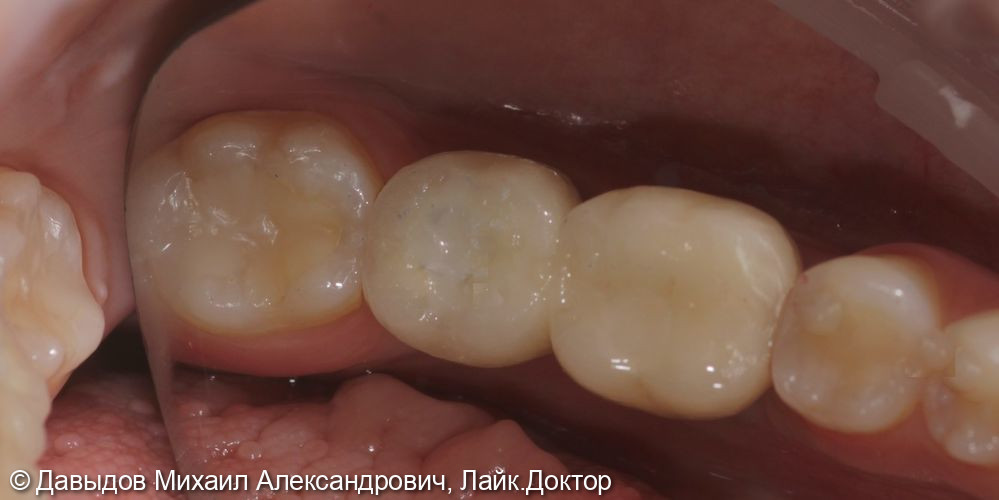 Протезирование зубов 46, 47 при помощи коронок из диоксида циркония на имплантах с винтоовой фиксацией - фото №7