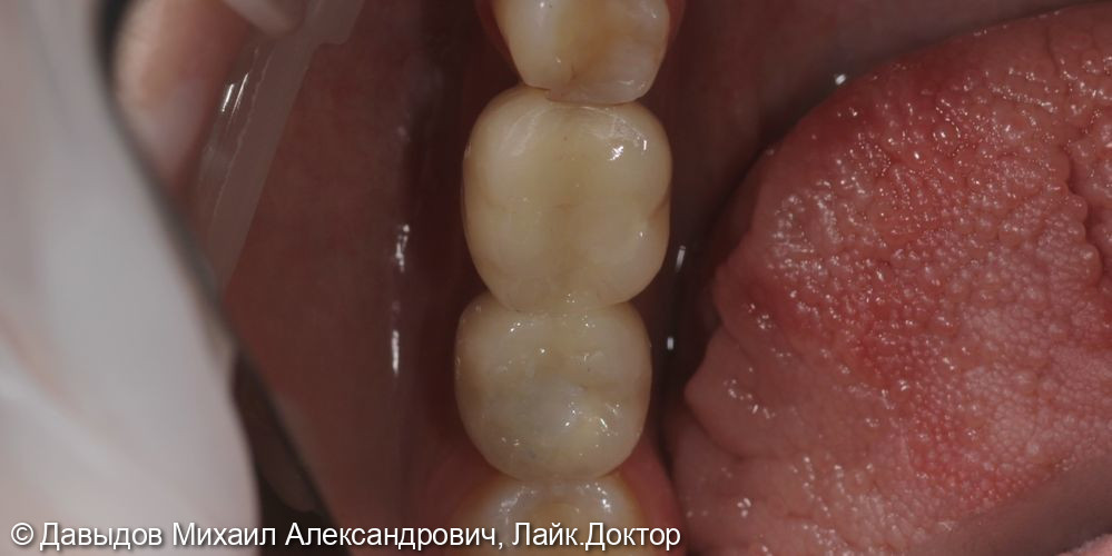 Протезирование зубов 46, 47 при помощи коронок из диоксида циркония на имплантах с винтоовой фиксацией - фото №8